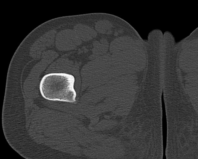 File:Chronic ostemyelitis of the femur with long sinus tract (Radiopaedia 74947-85982 Axial bone window 27).jpg