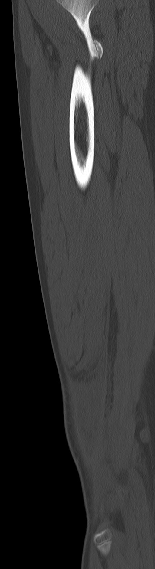 Chronic ostemyelitis of the femur with long sinus tract (Radiopaedia 74947-85982 Sagittal bone window 34).jpg
