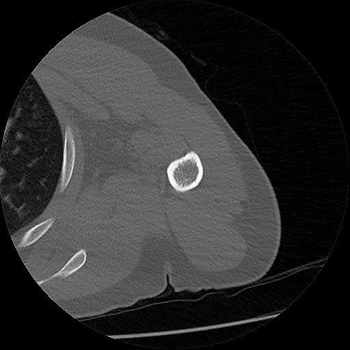 File:Chronic osteomyelitis (Radiopaedia 67597-76998 Axial bone window 17).jpg