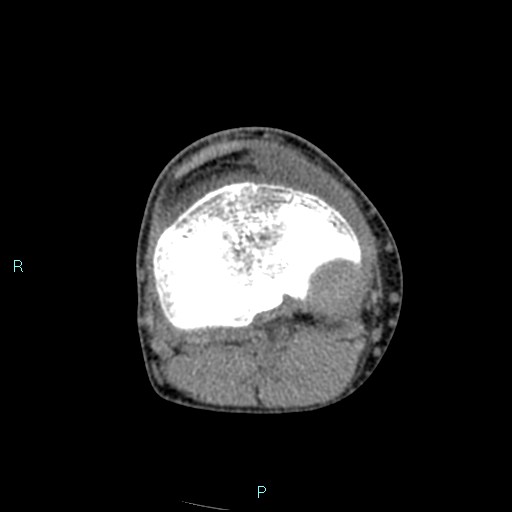 Chronic osteomyelitis (with Brodie abscess) (Radiopaedia 76405-88111 A 105).jpg