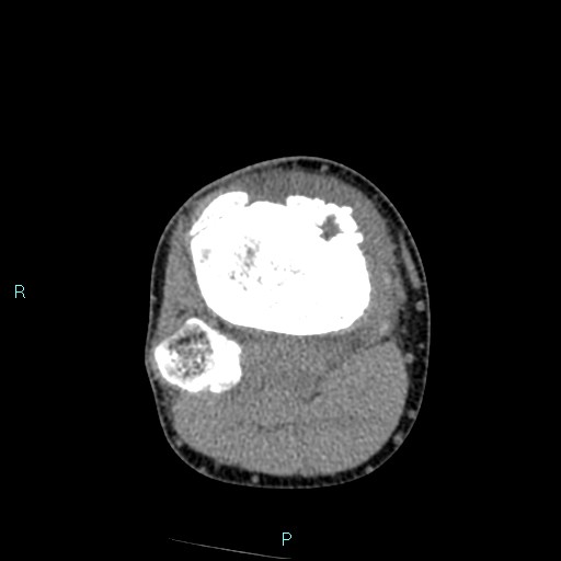 Chronic osteomyelitis (with Brodie abscess) (Radiopaedia 76405-88111 A 82).jpg