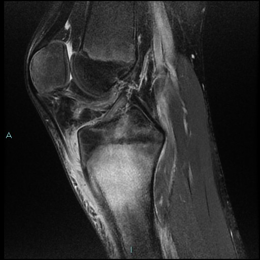 File:Chronic osteomyelitis (with Brodie abscess) (Radiopaedia 76405-88112 Sagittal PD fat sat 12).jpg