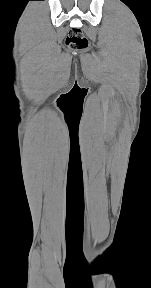 Chronic osteomyelitis (with sequestrum) (Radiopaedia 74813-85822 E 47).jpg