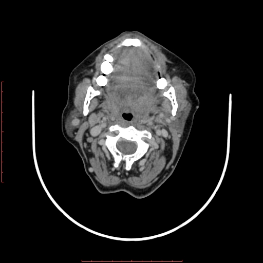 File:Chronic osteomyelitis - maxilla (Radiopaedia 23783-23927 B 42).jpg