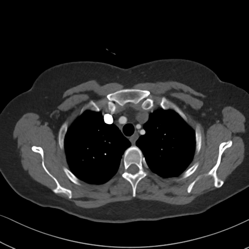 Chronic pulmonary embolus (Radiopaedia 39129-41341 Axial C+ CTPA 22).png