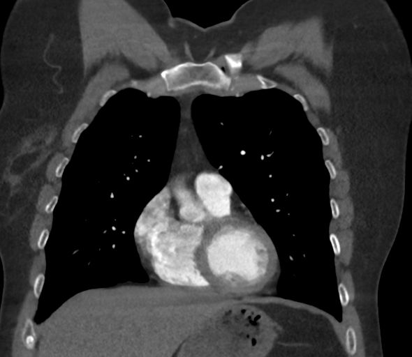 Chronic pulmonary embolus (Radiopaedia 39129-41341 Coronal C+ CTPA 30).png