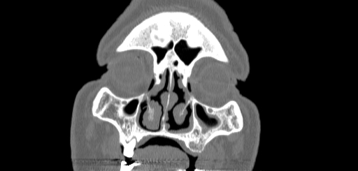 File:Chronic sphenoidal sinusitis (Radiopaedia 62030-70122 Coronal bone window 26).jpg