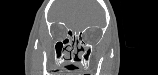 Chronic sphenoidal sinusitis (Radiopaedia 62030-70122 Coronal bone window 71).jpg