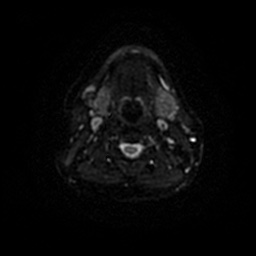 Chronic submandibular sialadenitis (Radiopaedia 61852-69885 Axial DWI 45).jpg