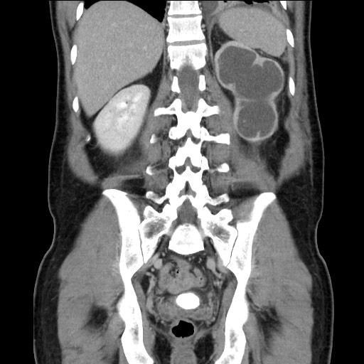 File:Chronic ureteropelvic junction obstruction (Radiopaedia 78365-90996 B 74).jpg