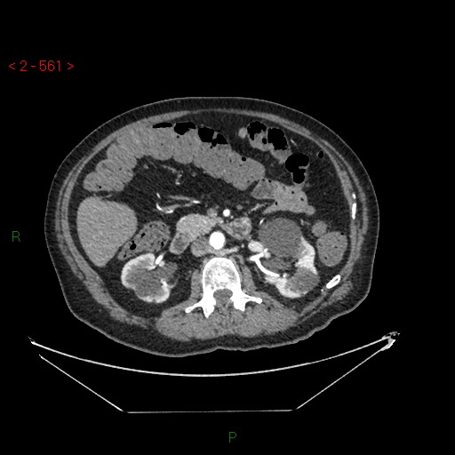 Circumaortic left renal vein and doubled left renal arteries (Radiopaedia 52268-58158 A 97).jpg