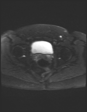 File:Class II Mullerian duct anomaly- unicornuate uterus with rudimentary horn and non-communicating cavity (Radiopaedia 39441-41755 Axial DWI 21).jpg
