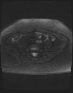 File:Class II Mullerian duct anomaly- unicornuate uterus with rudimentary horn and non-communicating cavity (Radiopaedia 39441-41755 Axial DWI 34).jpg