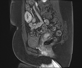 File:Class II Mullerian duct anomaly- unicornuate uterus with rudimentary horn and non-communicating cavity (Radiopaedia 39441-41755 G 42).jpg