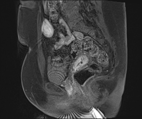 Class II Mullerian duct anomaly- unicornuate uterus with rudimentary horn and non-communicating cavity (Radiopaedia 39441-41755 G 51).jpg