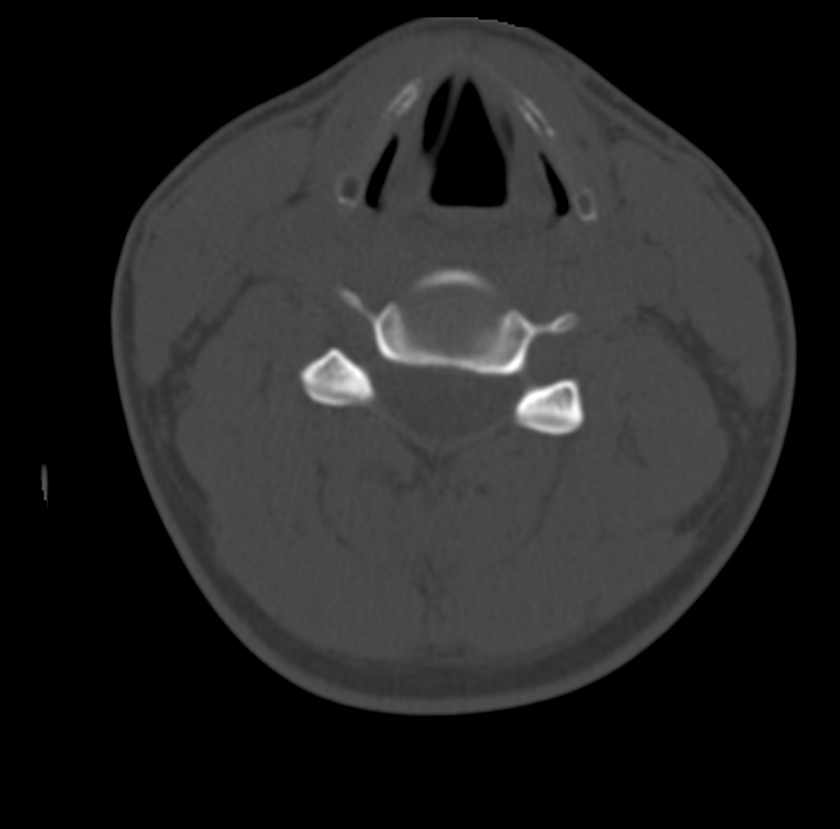 Clay-shoveler fracture (Radiopaedia 22568-22590 Axial bone window 40).jpg