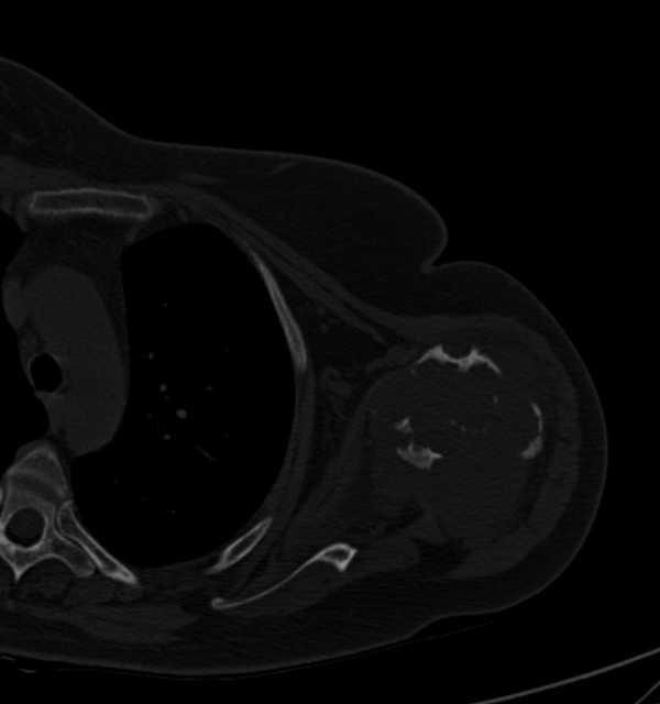 Clear cell chondrosarcoma - humerus (Radiopaedia 63104-71612 Axial bone window 55).jpg