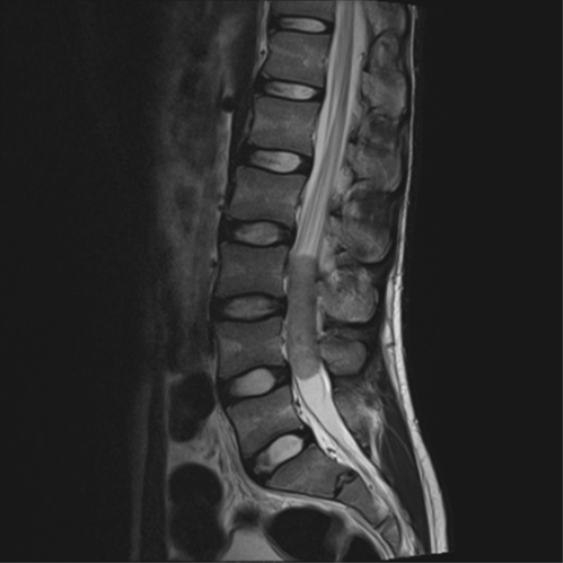 File:Clear cell meningoma - lumbar spine (Radiopaedia 60116-67690 Sagittal T2 9).png