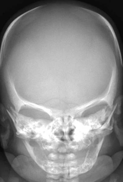 File:Cleidocranial dysostosis (Radiopaedia 11319-11683 B 1).jpg