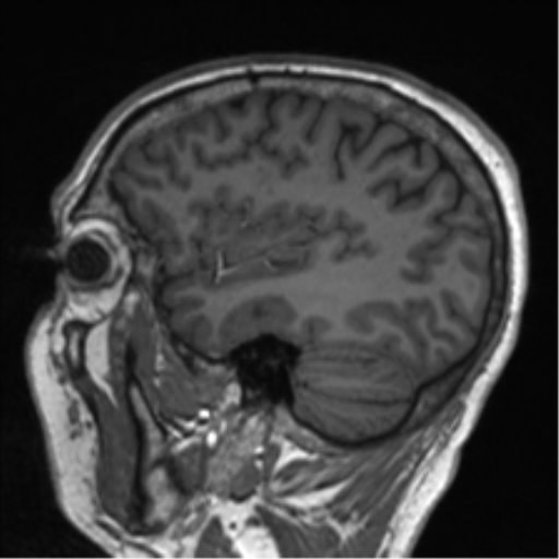 Clival chordoma invading the hypoglossal canal (Radiopaedia 48850-53887 Sagittal T1 28).png
