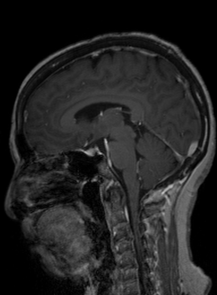 Clival meningioma (Radiopaedia 53278-59248 Sagittal T1 C+ 251).jpg
