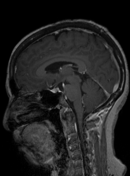 Clival meningioma (Radiopaedia 53278-59248 Sagittal T1 C+ 253).jpg