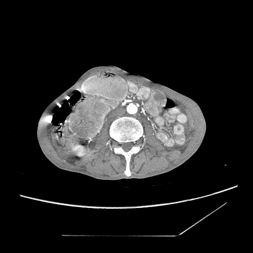 Closed-loop obstruction due to peritoneal seeding mimicking internal hernia after total gastrectomy (Radiopaedia 81897-95864 A 102).jpg