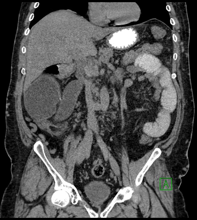 Closed-loop small bowel obstruction-internal hernia (Radiopaedia 78439-91096 Coronal non-contrast 53).jpg