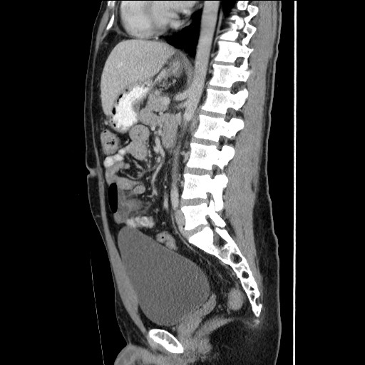 Closed-loop small bowel obstruction (Radiopaedia 73713-84509 B 94).jpg