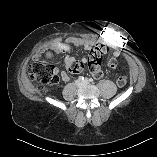 File:Closed loop obstruction - internal hernia into nephrectomy bed (Radiopaedia 59867-67320 A 91).jpg