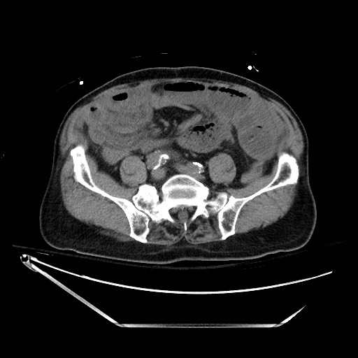File:Closed loop obstruction due to adhesive band, resulting in small bowel ischemia and resection (Radiopaedia 83835-99023 Axial non-contrast 106).jpg