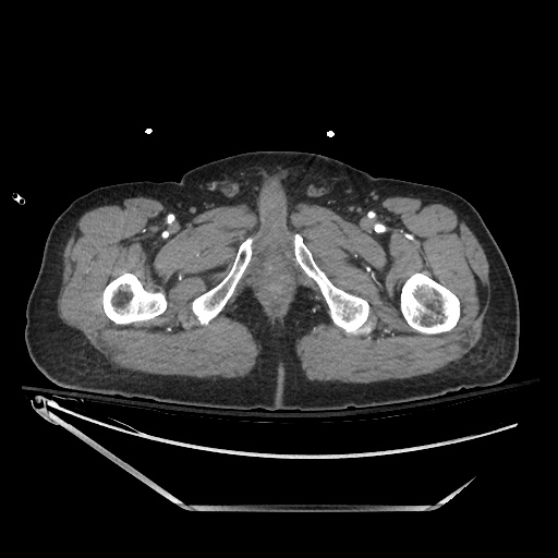 File:Closed loop obstruction due to adhesive band, resulting in small bowel ischemia and resection (Radiopaedia 83835-99023 B 167).jpg