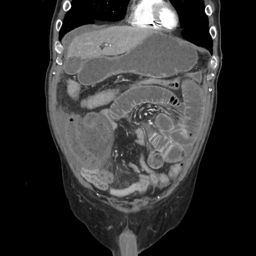 File:Closed loop obstruction due to adhesive band, resulting in small bowel ischemia and resection (Radiopaedia 83835-99023 C 39).jpg