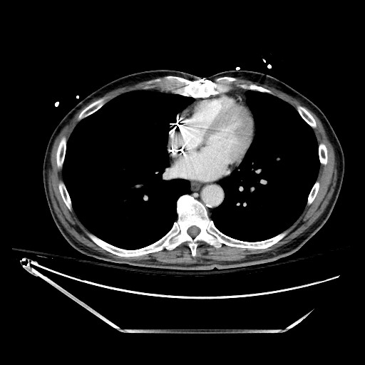 File:Closed loop obstruction due to adhesive band, resulting in small bowel ischemia and resection (Radiopaedia 83835-99023 D 7).jpg