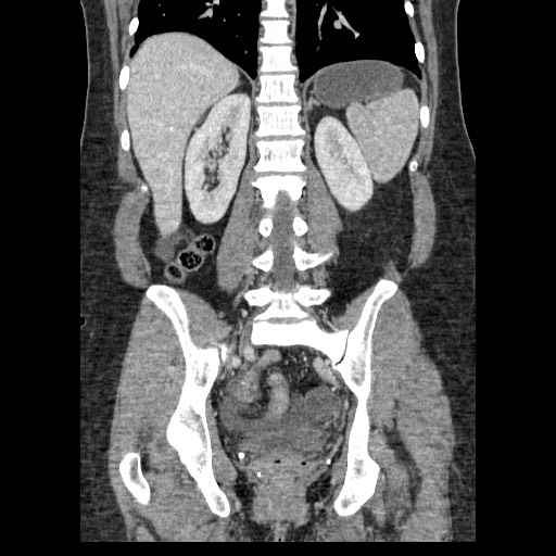 Closed loop small bowel obstruction (Radiopaedia 65403-74451 B 73).jpg