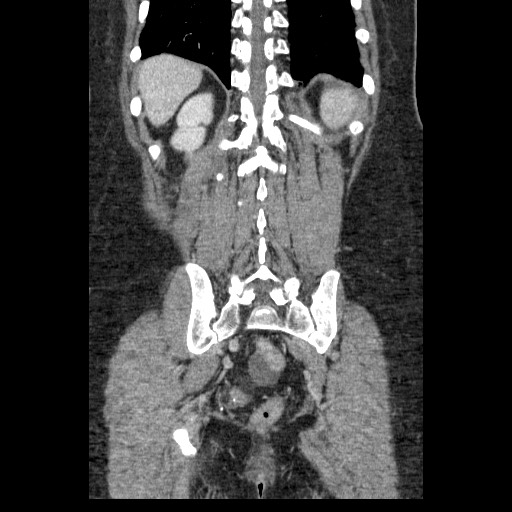 File:Closed loop small bowel obstruction (Radiopaedia 65403-74451 B 84).jpg
