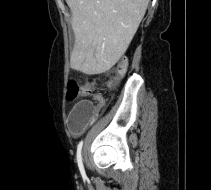 Closed loop small bowel obstruction (Radiopaedia 71211-81508 C 14).jpg