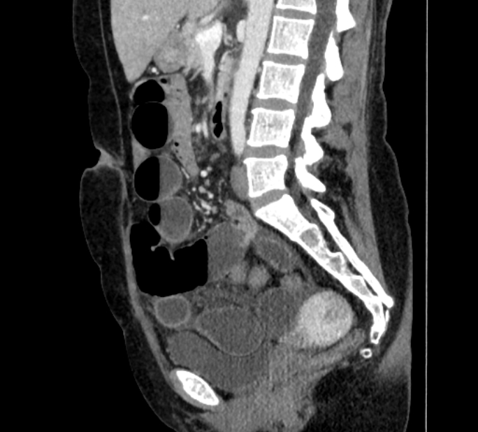 Closed loop small bowel obstruction (Radiopaedia 71211-81508 C 79).jpg