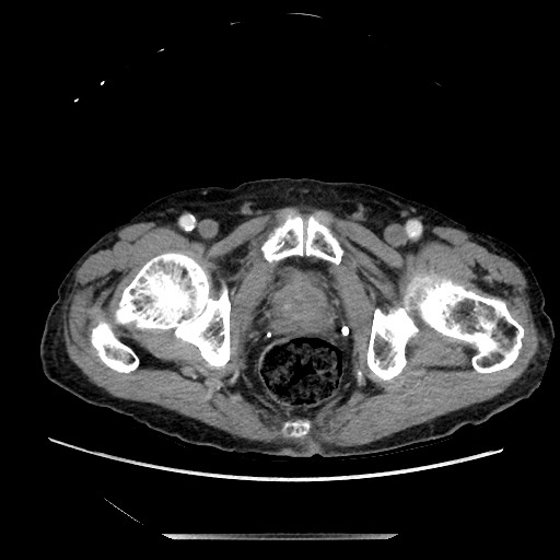File:Closed loop small bowel obstruction - adhesive disease and hemorrhagic ischemia (Radiopaedia 86831-102990 A 174).jpg
