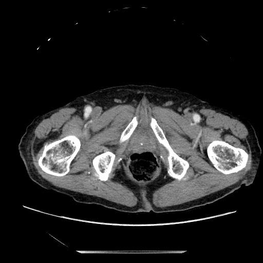 File:Closed loop small bowel obstruction - adhesive disease and hemorrhagic ischemia (Radiopaedia 86831-102990 A 183).jpg