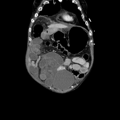 Closed loop small bowel obstruction - adhesive disease and hemorrhagic ischemia (Radiopaedia 86831-102990 B 32).jpg