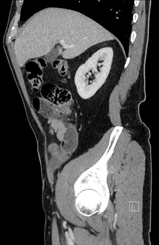 Closed loop small bowel obstruction - internal hernia (Radiopaedia 57806-64778 C 82).jpg