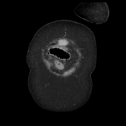 Closed loop small bowel obstruction - internal hernia (Radiopaedia 65402-74450 B 9).jpg