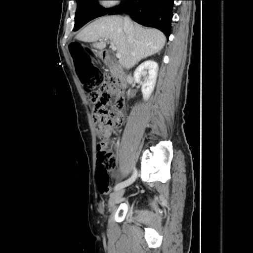 Closed loop small bowel obstruction - omental adhesion causing "internal hernia" (Radiopaedia 85129-100682 C 71).jpg
