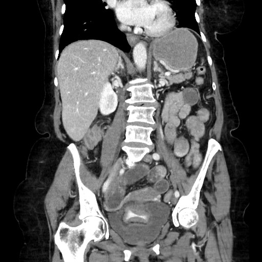 File:Closed loop small bowel obstruction due to adhesive band, with intramural hemorrhage and ischemia (Radiopaedia 83831-99017 C 69).jpg