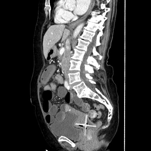 Closed loop small bowel obstruction due to adhesive band, with intramural hemorrhage and ischemia (Radiopaedia 83831-99017 D 103).jpg