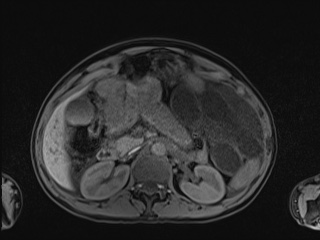 Closed loop small bowel obstruction in pregnancy (MRI) (Radiopaedia 87637-104031 Axial T1 fat sat 44).jpg