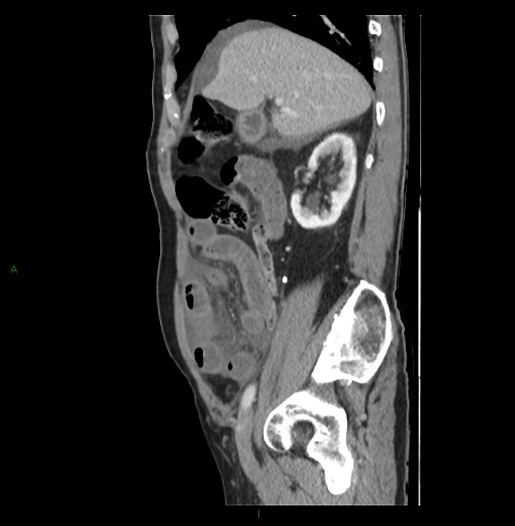 Closed loop small bowel obstruction with ischemia (Radiopaedia 84180-99456 C 30).jpg