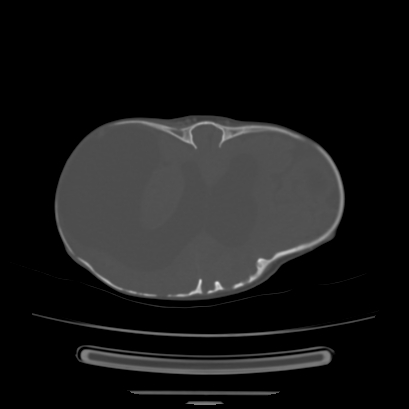 Cloverleaf skull (Radiopaedia 91901-109710 Axial bone window 102).jpg
