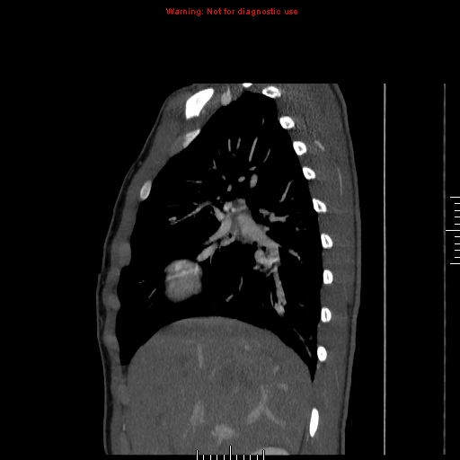 Coarctation of the aorta (Radiopaedia 9434-10118 B 11).jpg